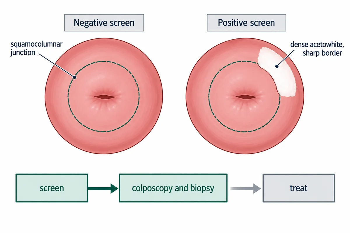 Two drawn cervices: one plain, the other with a dense white patch of one quadrant with a hard border touching the squamocolumnar junction ring, above a three-box pathway in which screen and colposcopy are highlighted and treat is left detached and plain