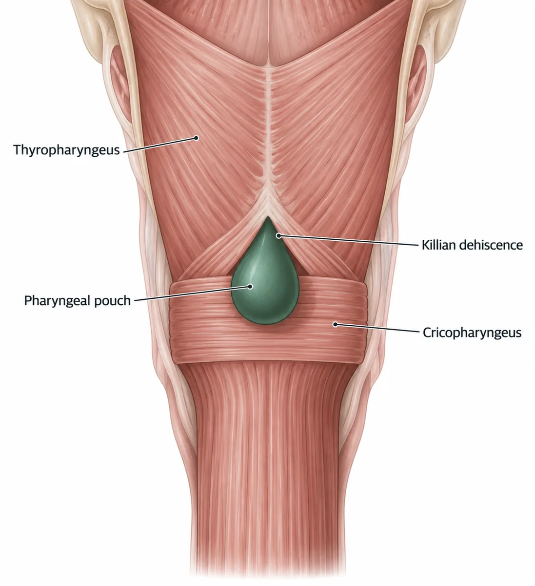 The posterior pharyngeal wall showing Killian dehiscence as the gap between the oblique fibres of thyropharyngeus above and the horizontal fibres of cricopharyngeus below.