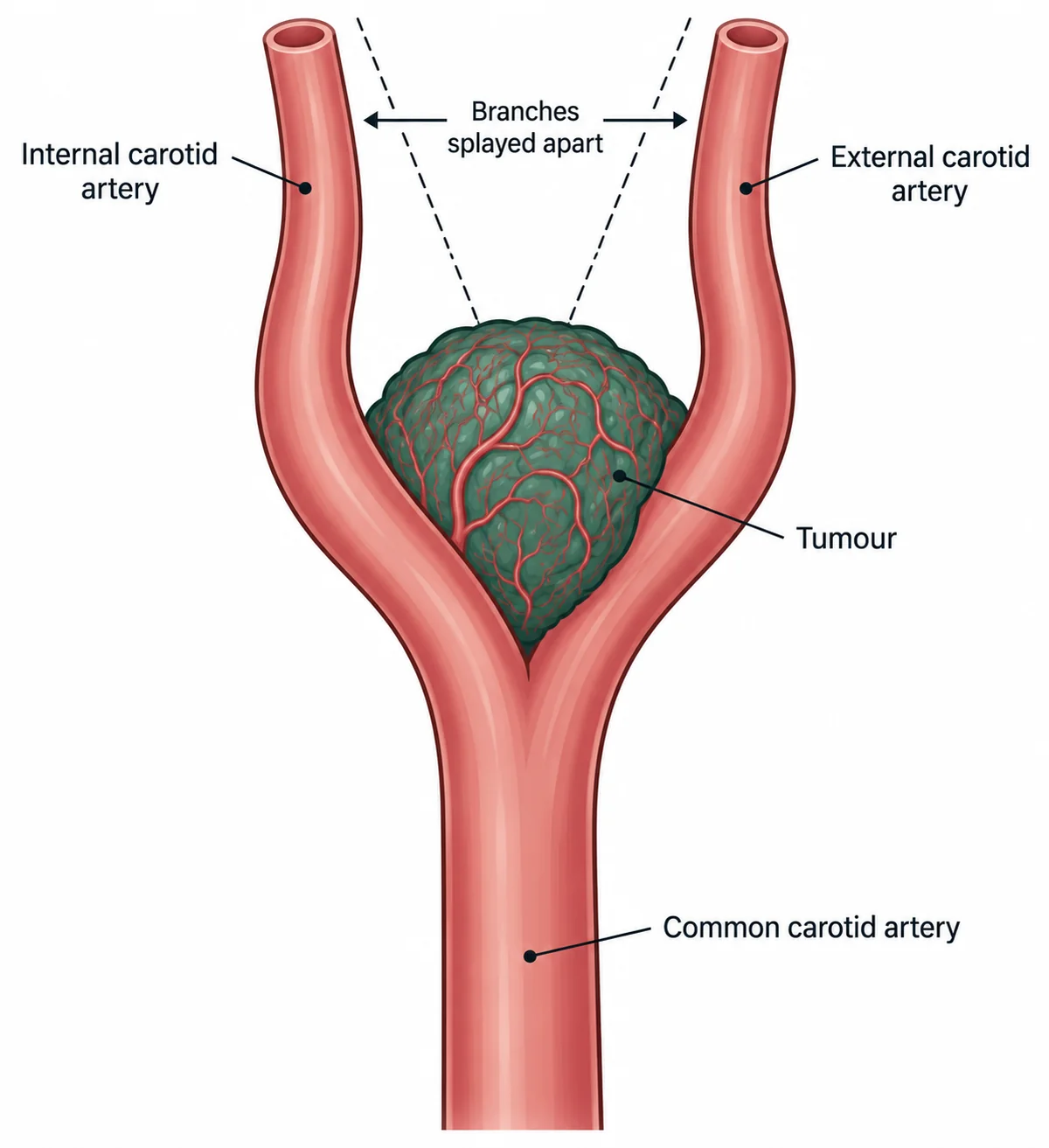 The common carotid artery dividing into internal and external carotid branches, with a rounded vascular mass sitting in the crotch of the bifurcation and splaying the two branches apart so their outline resembles the arms of a lyre
